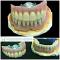 Overdenture superiore su 4 impianti